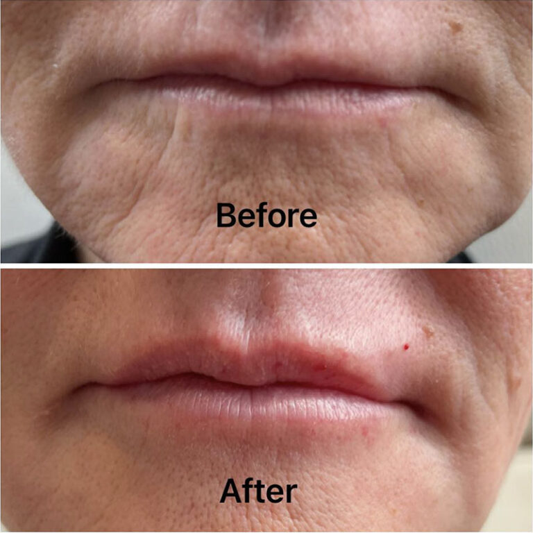 Dermal Filler & Lip Enhancement in Cambridge Hardwick Clinic