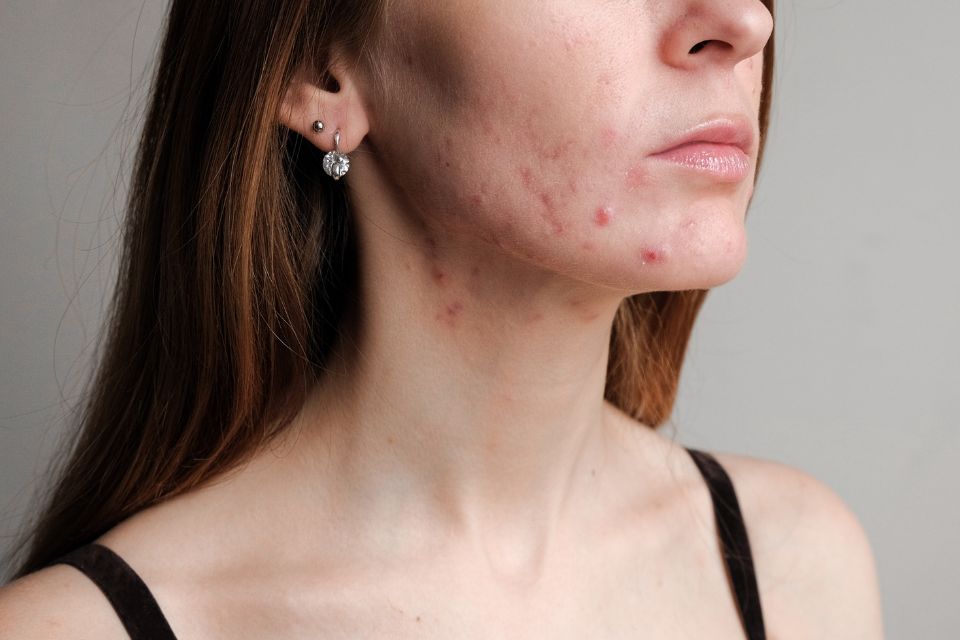 Acne Treatment in Cambridge