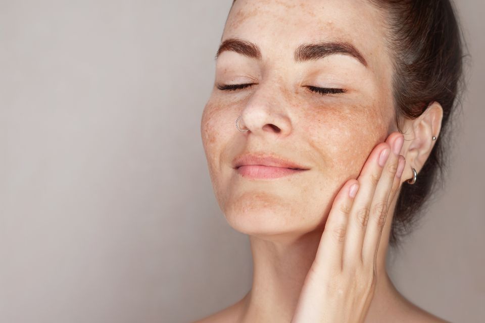 Melasma Treatment in Cambridge