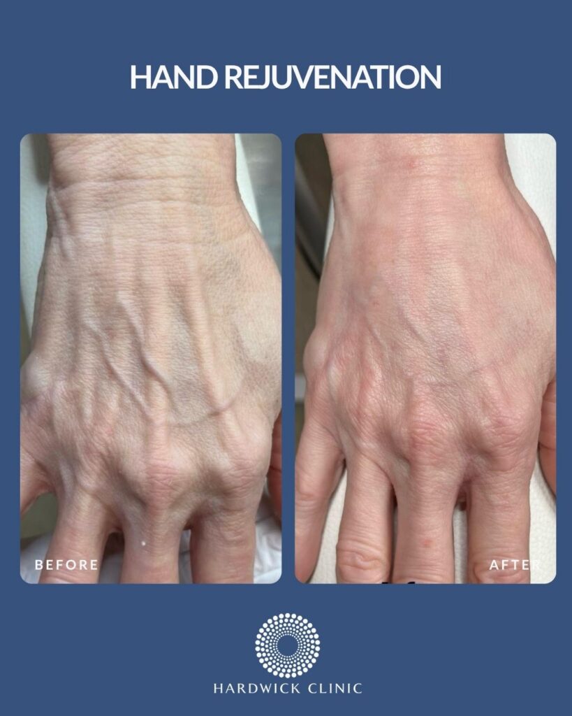 Hand rejuvenation